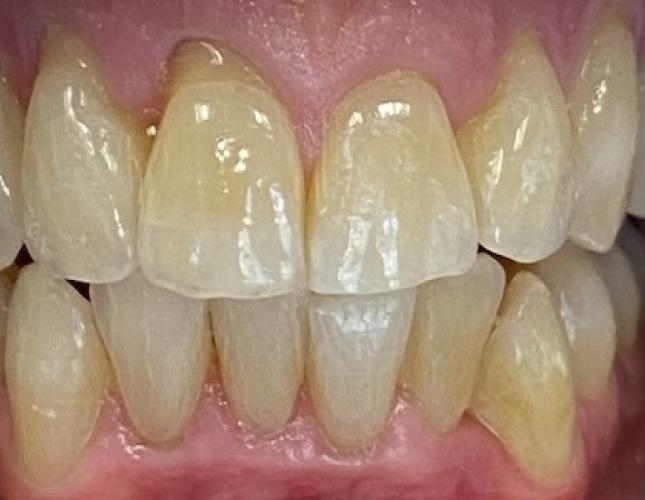 Invisalign after