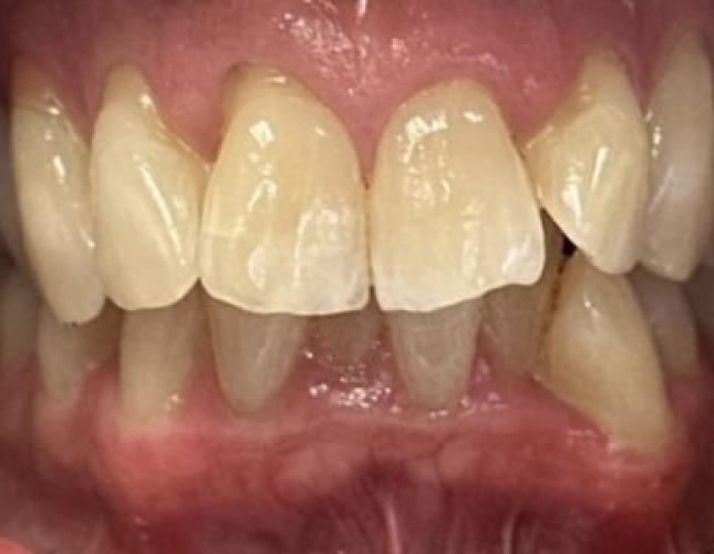 Invisalign before