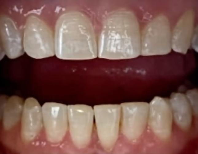 Invisalign 2 after