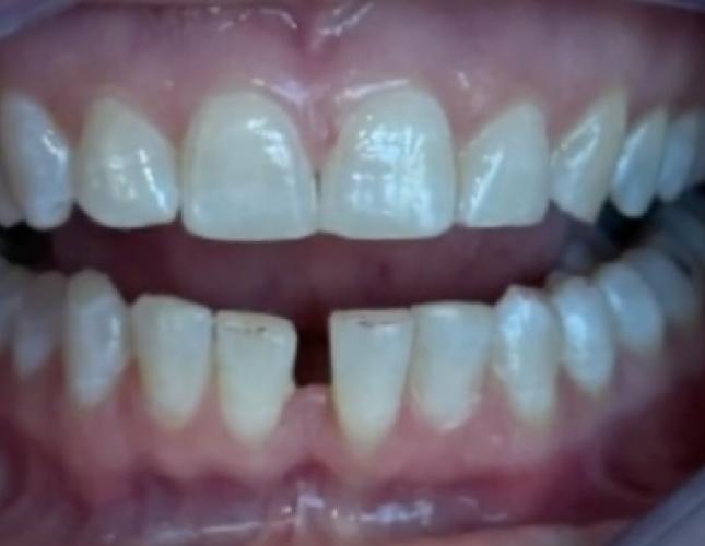 Invisalign 2 before