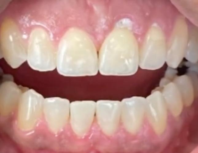 Invisalign 4 after