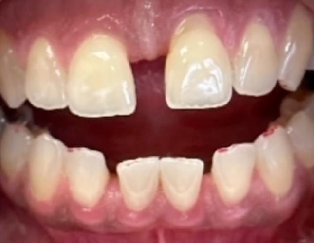 Invisalign 4 before
