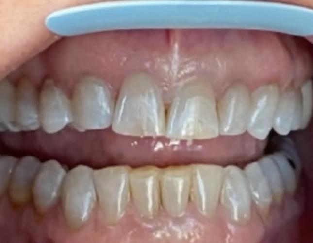 Invisalign 1 after