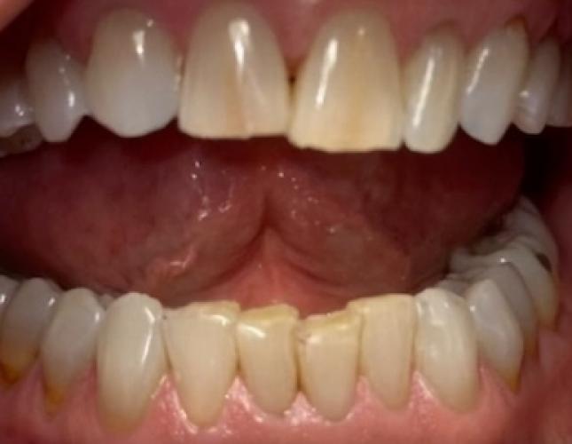 Invisalign 1 before