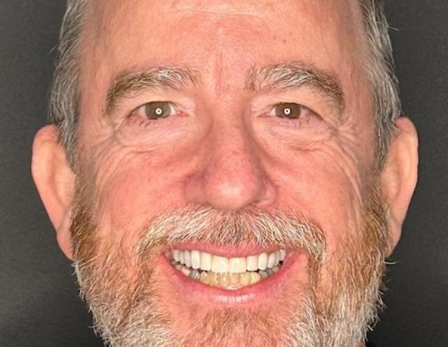 Invisalign with crown after